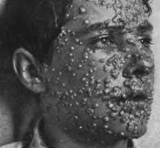 smallpox