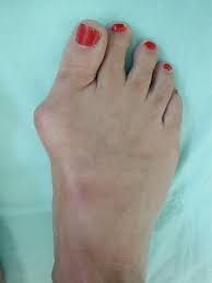 bunion