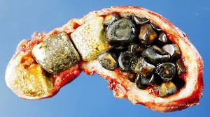 gallstones