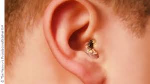 swimmers ear.jpeg